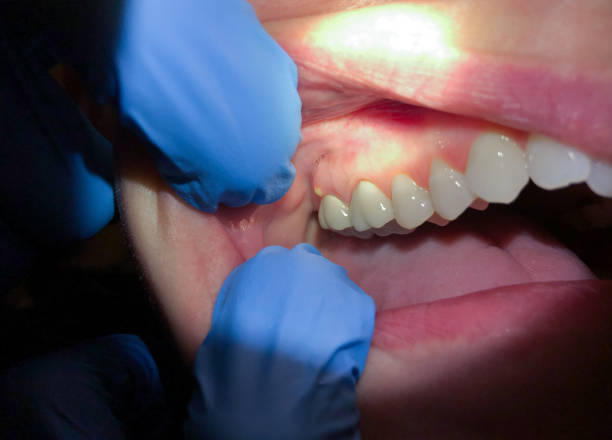 Best Chipped Tooth Repair Near Me  in Madison, AL